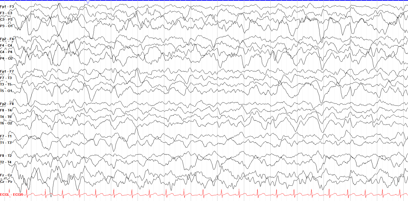 Slow wave sleep
